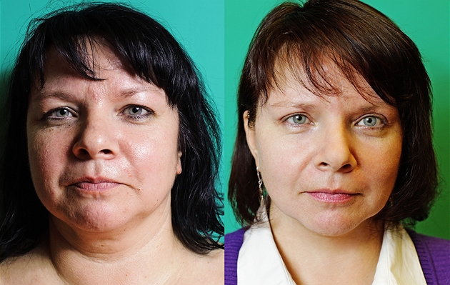 Čtenářka Jaroslava před (vlevo) a po (vpravo) zákrocích na klinice MEDICOM VIP