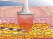 Radiofrekven�n� liposukce na klinice Asklepion. Revoluce v plastick� chirurgi