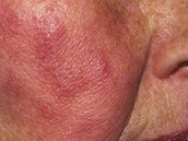 Kožní vyrážka u autoimunitního onemocnění lupus erythematosus. Ilustrační snímek