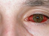 Kapavka se může projevit i v očích. U postiženého oka je zarudlá oční spojivka... Kapavka se může projevit i v očích. U postiženého oka je zarudlá oční spojivka...