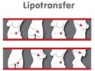 Může vám tuk slušet? Ano, díky nové metodě lipotransfer