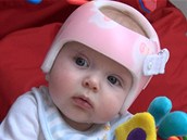 Helmička pomáhá srovnat deformity dětské hlavičky. Helmička pomáhá srovnat deformity dětské hlavičky.