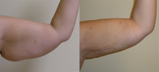 Co umí SlimLipo - laserem asistovaná liposukce? Co umí SlimLipo - laserem asistovaná liposukce?