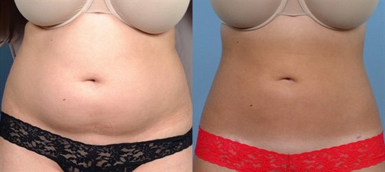 Co umí SlimLipo - laserem asistovaná liposukce? Co umí SlimLipo - laserem asistovaná liposukce?