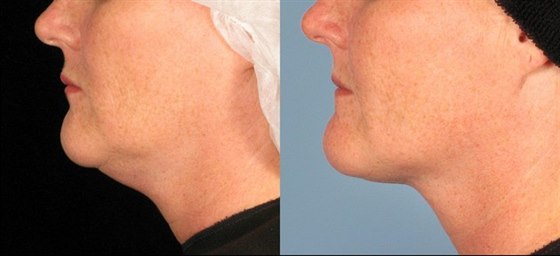 Co umí SlimLipo - laserem asistovaná liposukce? Co umí SlimLipo - laserem asistovaná liposukce?