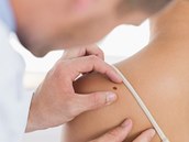 Přehlédnutá nová piha může skončit vážnou nemocí. Přehlédnutá nová piha může skončit vážnou nemocí.
