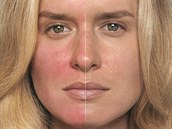 Stále červený obličej je příznakem nemoci zvané rosacea. Stále červený obličej je příznakem nemoci zvané rosacea.